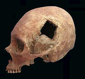 Uno de los cráneos descubiertos por los arqueólogos, con un gran agujero donde se realizó una operación. (Foto: Valerie Andrushko)