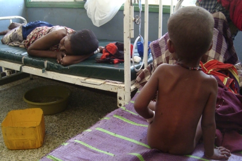 Un niño malnutrido sentado en la cama de un hospital en Mogadiscio.| AP