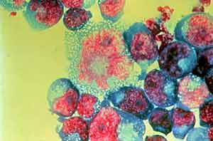 Células T infectadas por el VIH. (Foto: cortesía del Dr. Tom Folks, NIAID | NIH) Células T infectadas por el VIH. (Foto: cortesía del Dr. Tom Folks, NIAID | NIH)