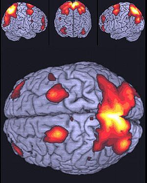 Imagen de resonancia magnética de un sujeto con talento matemático (Foto: Laboratorio de imagen Hospital Gregorio Marañón)