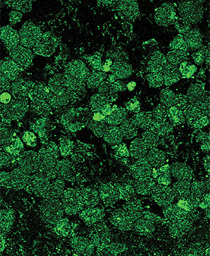 Esta fotograf&iacute;a de las c&eacute;lulas de un linfoma ocupan la portada de la revista 'Cancer Research'