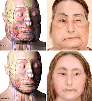 El antes y el después de la paciente (Foto: Archives of Facial Plastic Surgery)