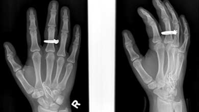 Imagen de rayos X muestra tres grapas de metal incrustadas en la mano. | RSNA
